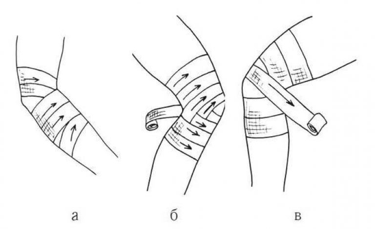 Перевязка локтя. Колосовидная повязка на плечевой сустав алгоритм. Колосовидная повязка алгоритм. Черепашья сходящаяся на локтевой сустав повязка. Техника наложения колосовидной повязки на плечо.