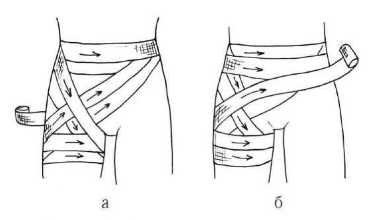 Тейпирование паховой грыжи у мужчин схема